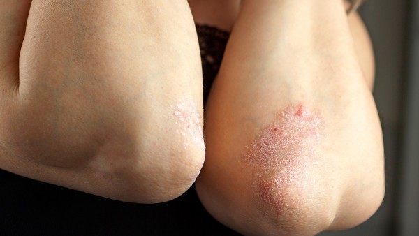 中药治银屑病效果怎么样 青年关节病型牛皮癣中药方