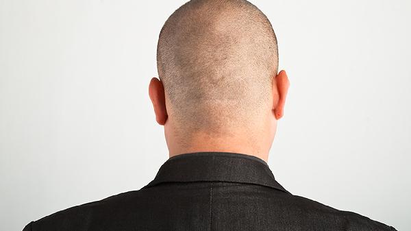 蔓迪用于治疗男性脱发期间需要注意些什么