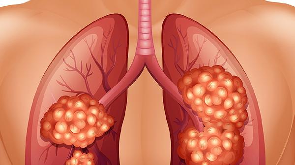 肿瘤的中医治疗秘方有哪些?