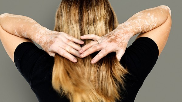 鼻咽炎的最明显症状 鼻咽炎吃什么药治疗