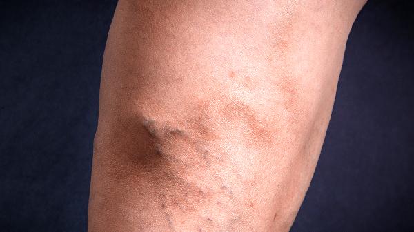 使用安普莱士会经常性出现不良反应吗