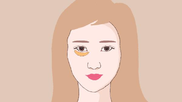 做胶原蛋白填充泪沟手术多少钱?