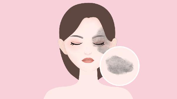 去太田痣失败修复手术术后护理?