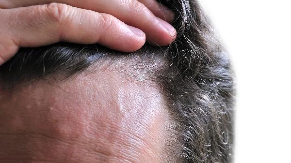 白头发为什么越拔越多不建议