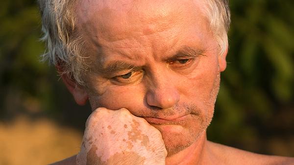 男性频繁洗澡会得皮肤癌吗