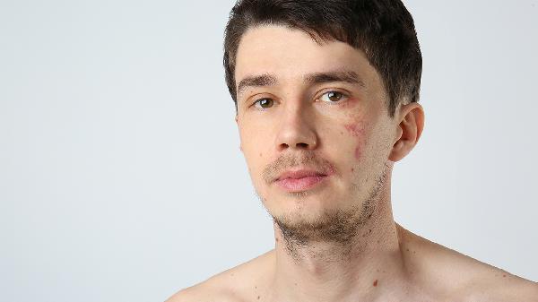 做激光去太田痣手术注意事项是什么?