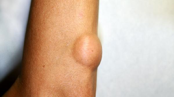 皮肤纤维瘤是怎么引起的原因有哪些