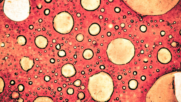 念珠菌感染该怎么办呢 念珠菌感染吃什么药好