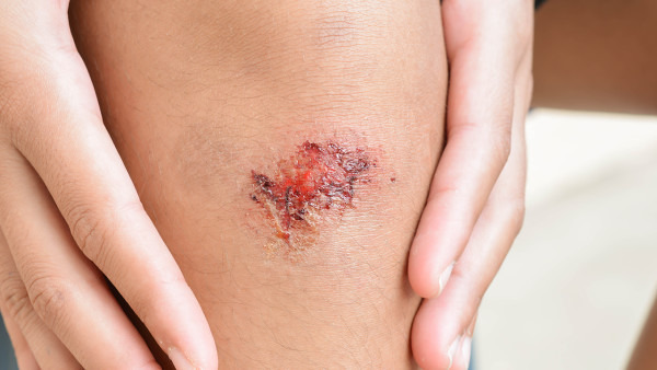 云南白药喷雾剂的使用方法是什么 云南白药喷雾剂的用法说明