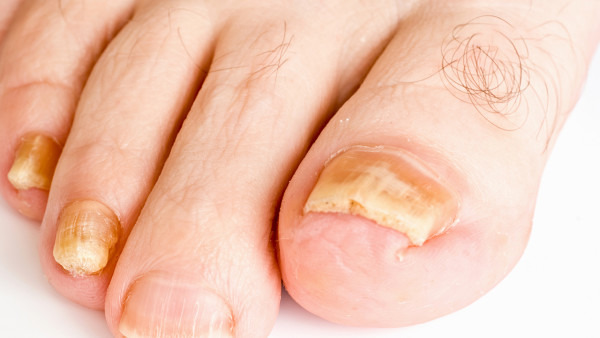 治疗灰指甲便宜又好用的药是什么 治疗灰指甲的药有哪些
