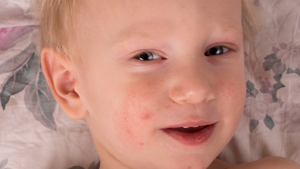 小孩身上起荨麻疹吃什么药  小儿荨麻疹吃什么药