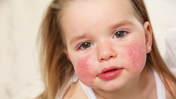婴儿湿疹该怎么治疗好 婴儿湿疹的治疗药物有哪些