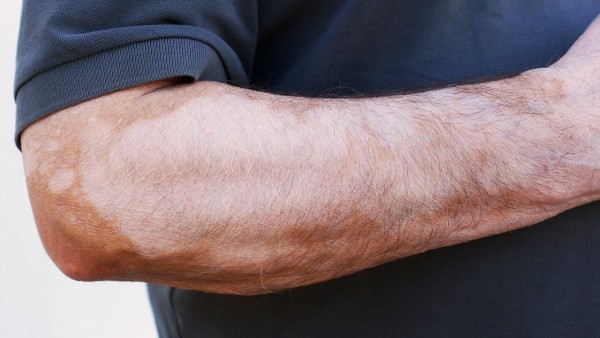 桃红清血片治疗白癜风真的有效吗  桃红清血片的功效是什么