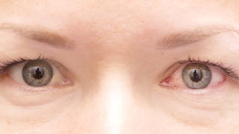 使用富马酸依美斯汀滴眼液有什么需要注意的呢 适应症是什么