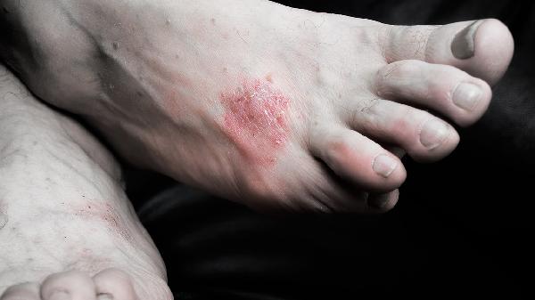 黑色素缺失怎么办