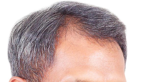 白头发缺少什么维生素.需要吃什么