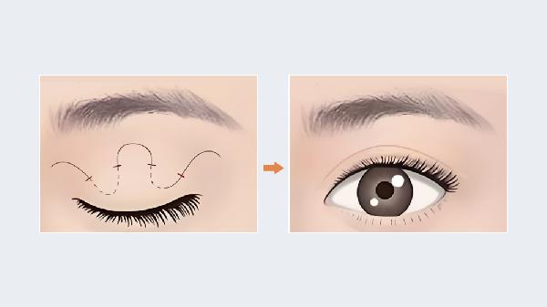 埋线双眼皮手术大致要多少钱