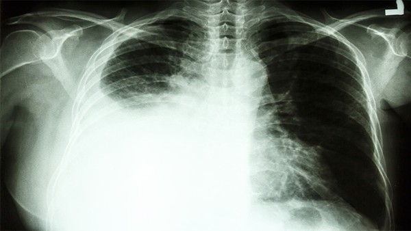支气管肺癌最常见的早期症状是什么？