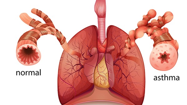 支气管哮喘吃什么药有效？支气管哮喘患者不宜吃哪些食物？