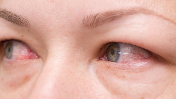 治疗眼睛角膜炎用哪些药最好 眼睛角膜炎如何治疗