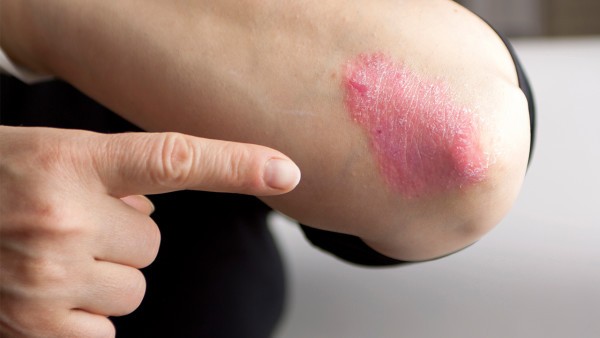 牛皮癣外用药有什么推荐吗  维甲酸类外用药物治疗牛皮癣吗