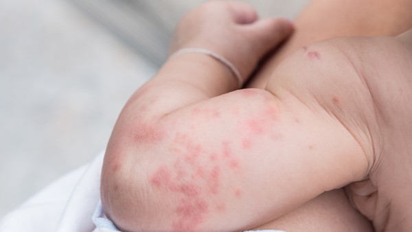 婴儿身上起湿疹用什么药  宝宝湿疹该怎么办