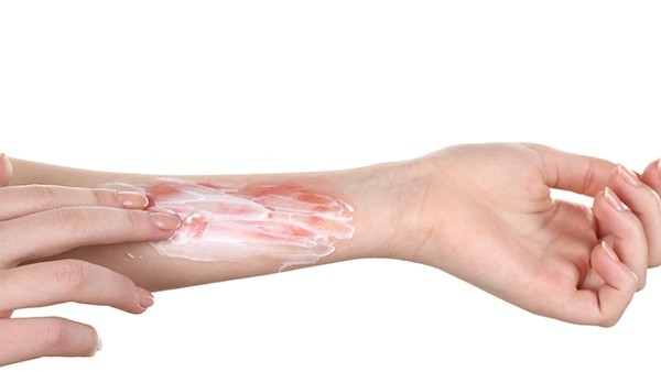 手冻伤刺痛用什么药可以缓解 手冻伤可以涂茶油吗