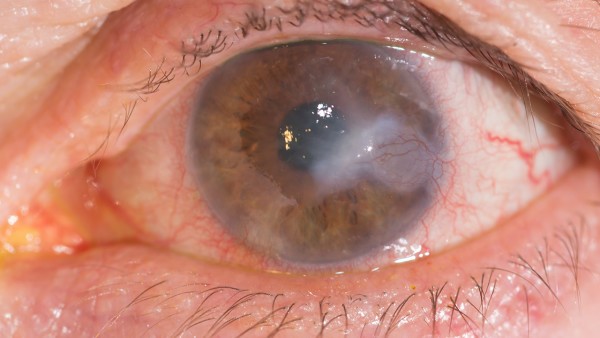 普拉洛芬滴眼液的说明书内容  普拉洛芬滴眼液副作用多久能消退