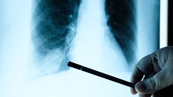 肺癌晚期胸腔积液咳嗽等症状