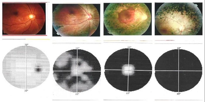 手术治疗“视网膜色素变性”历程回顾 愿失明不是必然