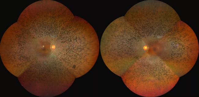 视网膜色素变性专家杨春华：视网膜色素变性是怎么回事