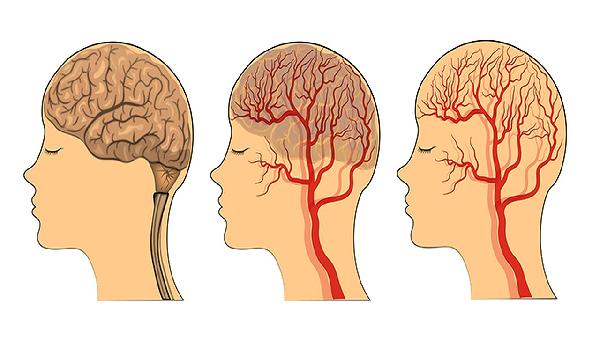 大脑镰钙化灶会引起哪些症状