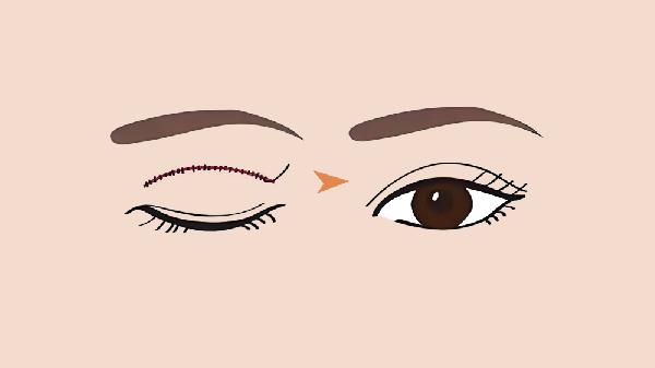 做双眼皮手术前要做什么准备