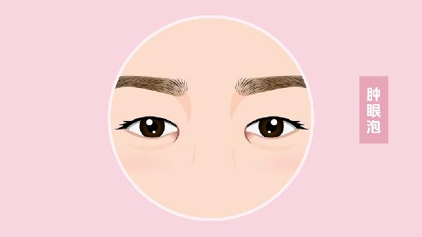 眶隔脂肪释放消除肿眼泡手术时间需要多久？