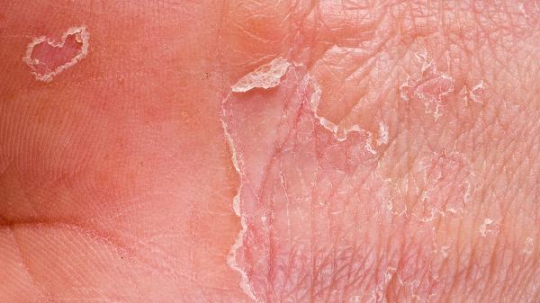 胼胝体发育不良的孩子怎么治疗好