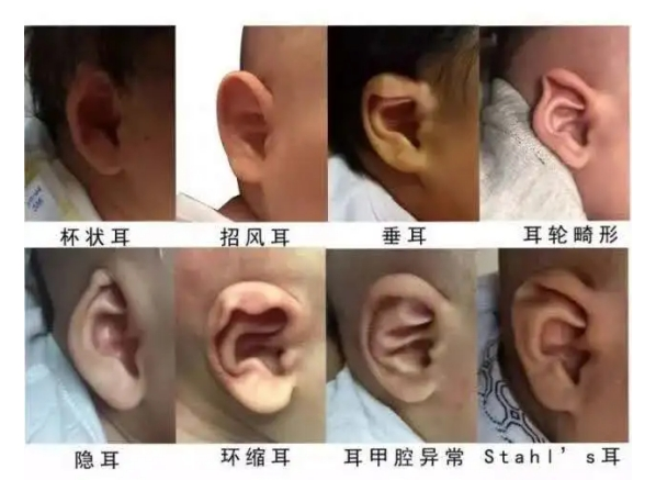 小耳畸形孩子几岁做耳再造最好？广药附一余文林主任解答