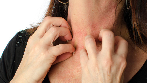 去湿疹的中成药有哪些  治疗湿疹的中成药介绍