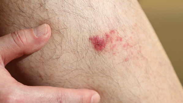 点痣后留疤怎么办？听听专家的意见