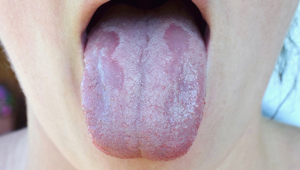 舌苔厚白是什么原因造成的  舌苔厚白吃什么药