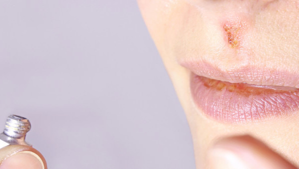 口角炎吃什么药治疗好  口角炎唇炎该如何治疗